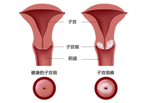 咸阳妇女患宫颈癌的前兆有哪些
