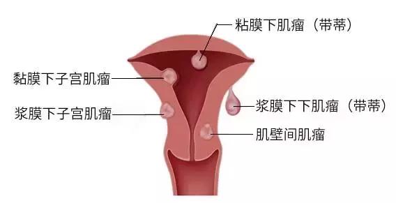 咸阳妇女子宫肌瘤11厘米怎么办