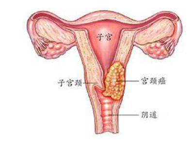咸阳女性宫颈出血是不是宫颈癌