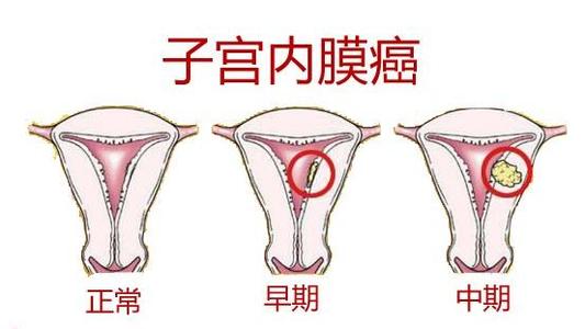 咸阳丽人妇科医院检查子宫内膜癌的方法有哪些