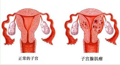 咸阳妇女患子宫肌瘤的注意事项