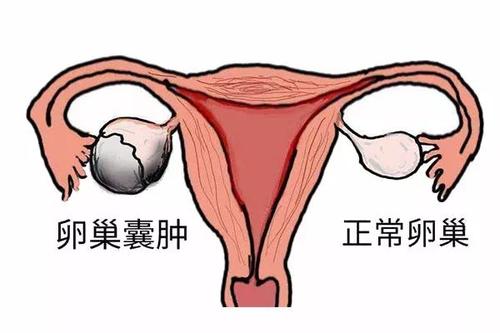咸阳妇女如何判断卵巢囊肿是良性还是恶性