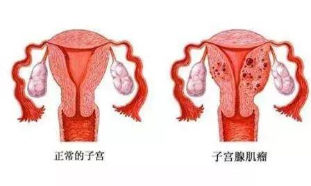 咸阳妇女子宫肌瘤是因为宫寒吗