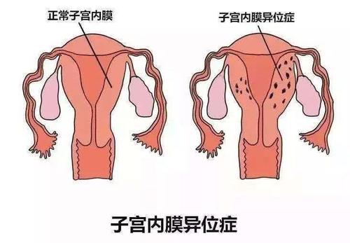 咸阳妇女子宫内膜异位检查是怎样的